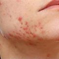 Skin conditions - acne