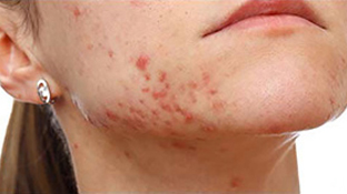 Skin conditions - acne